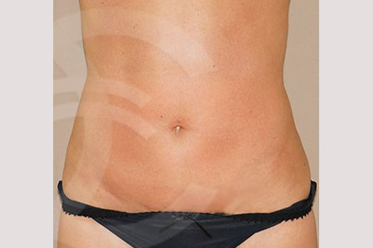 Tummy Tuck WITH LIPOSCULPTURE ante/post-op I