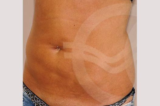 Tummy Tuck WITH LIPOSCULPTURE ante/post-op II