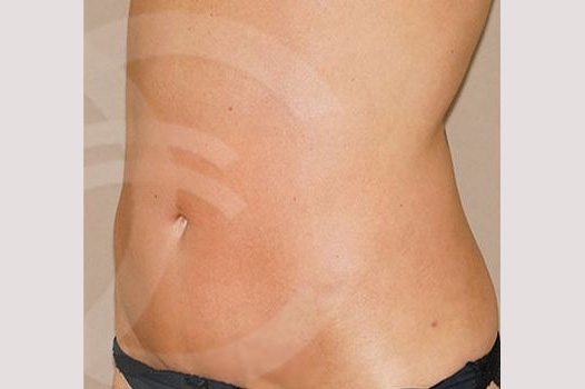 Tummy Tuck WITH LIPOSCULPTURE ante/post-op II