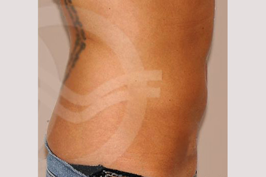 Photos Tummy Tuck  ante/post-op III