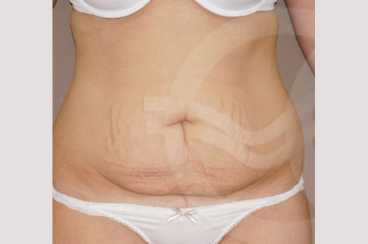 Photos Tummy Tuck  ante/post-op I