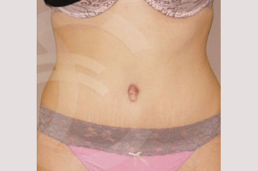 Photos Tummy Tuck  ante/post-op I
