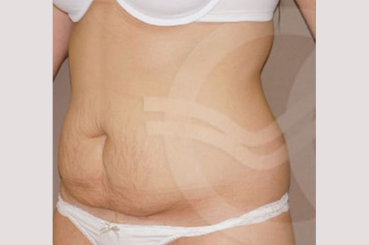 Photos Tummy Tuck  ante/post-op II
