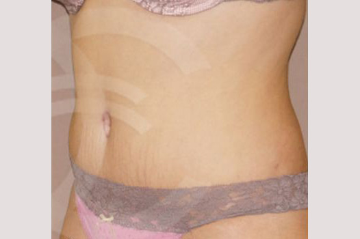 Photos Tummy Tuck  ante/post-op II