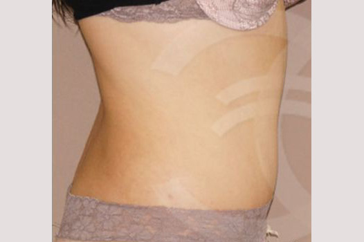Photos Tummy Tuck  ante/post-op III