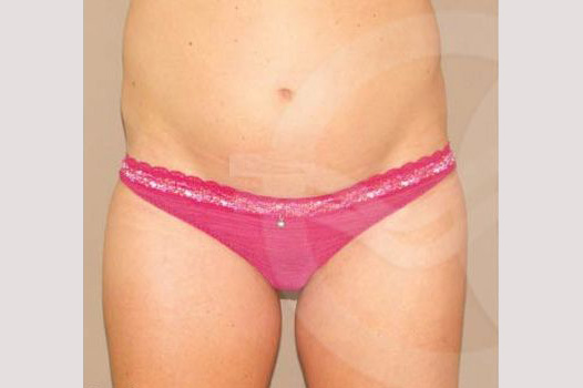 Photos Tummy Tuck  ante/post-op I