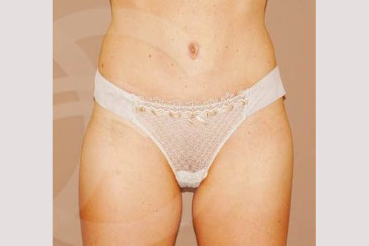Photos Tummy Tuck  ante/post-op I