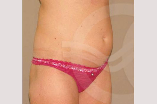 Tummy Tuck UMBILICAL HERNIA REPAIR ante/post-op II