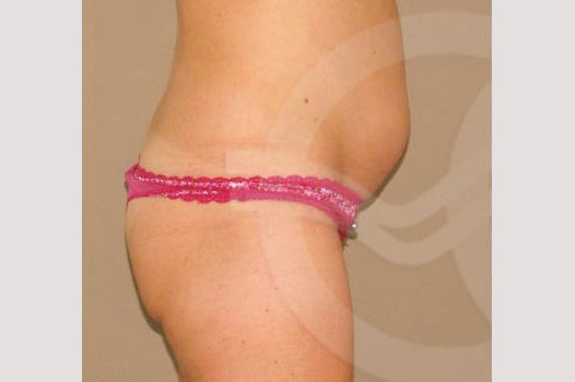 Tummy Tuck UMBILICAL HERNIA REPAIR ante/post-op III