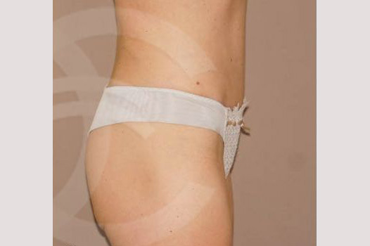 Tummy Tuck UMBILICAL HERNIA REPAIR ante/post-op III