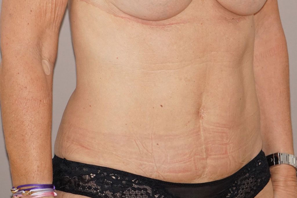 Bauchdeckenstraffung ABDOMINOPLASTIK ante/post-op II