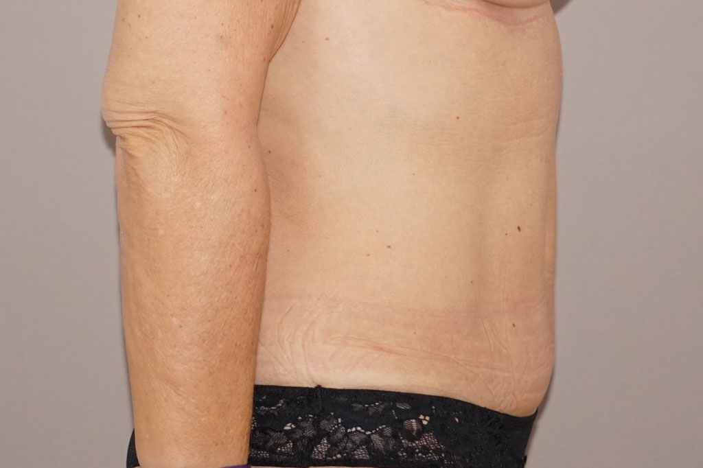 Abdominoplastie 1 ante-op retro/lateral