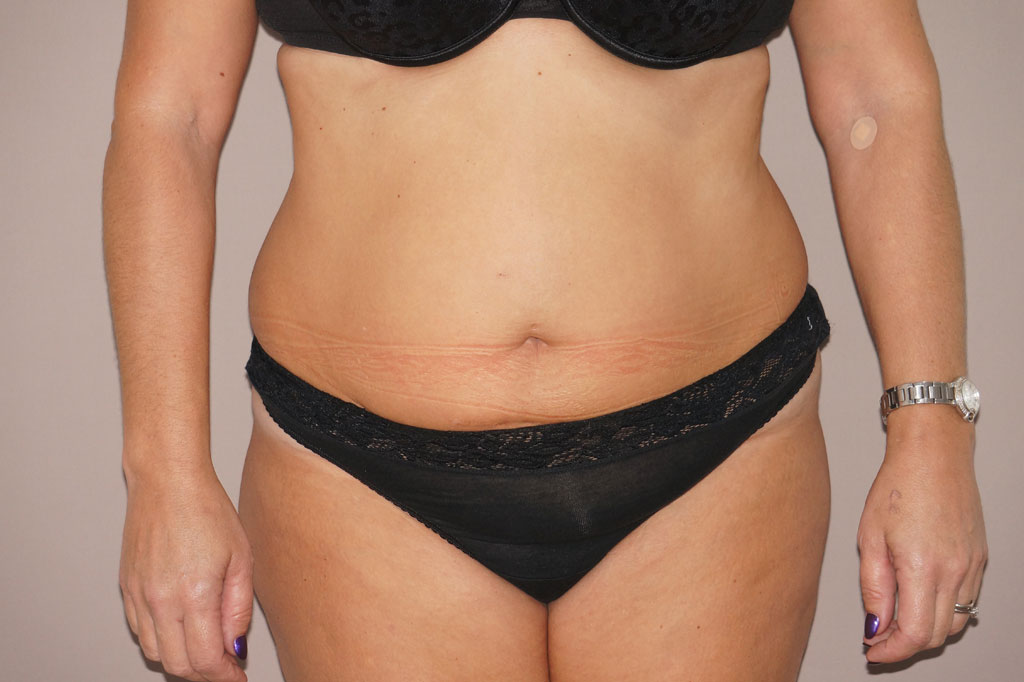 Abdominoplastie 2 ante-op profil