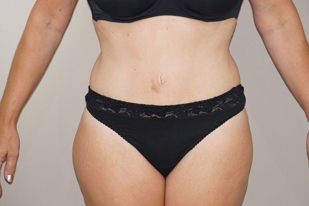 Bauchdeckenstraffung 22 BAUCHSTRAFFUNG ABDOMINOPLASTIK ERSTKLASSIGES ERGEBNIS post-op profil