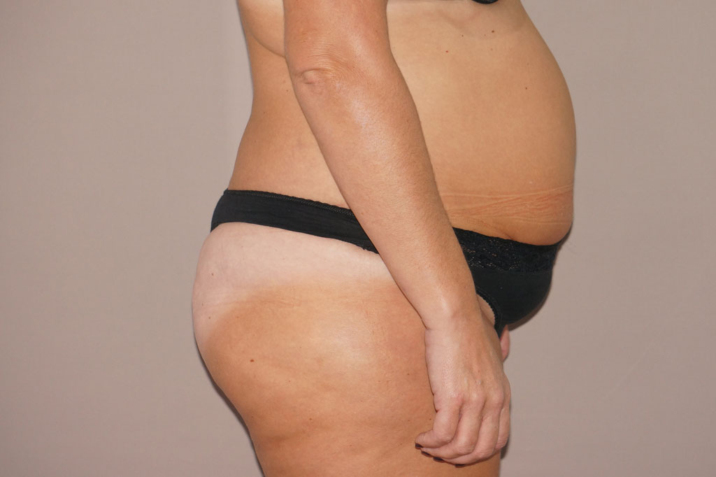 Tummy Tuck Abdominoplasty ante-op lateral