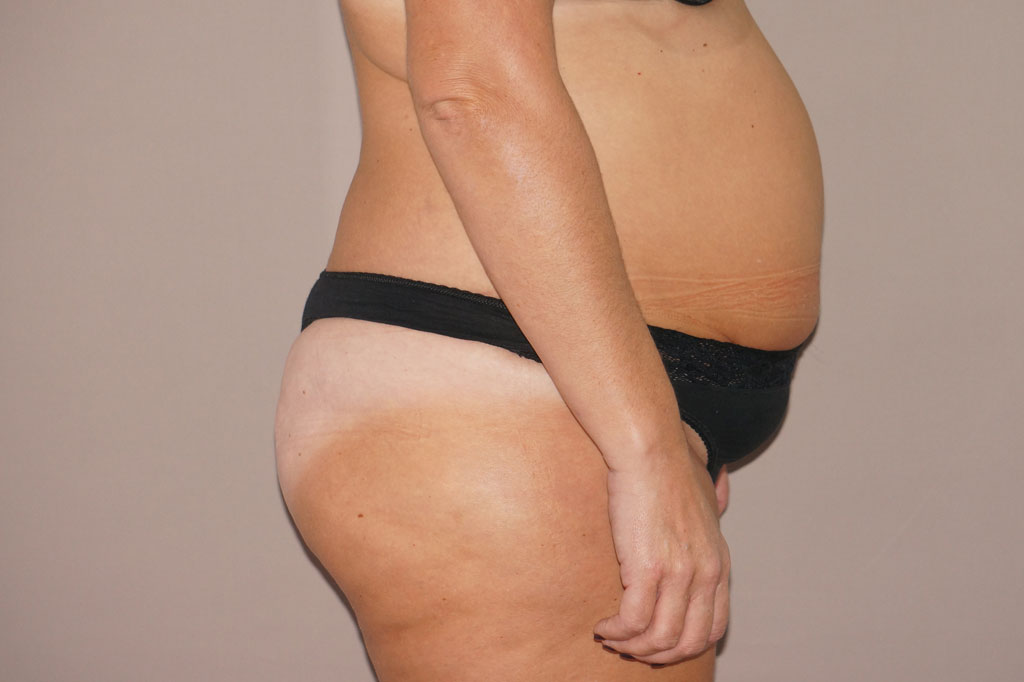 Abdominoplastie 2 ante-op lateral