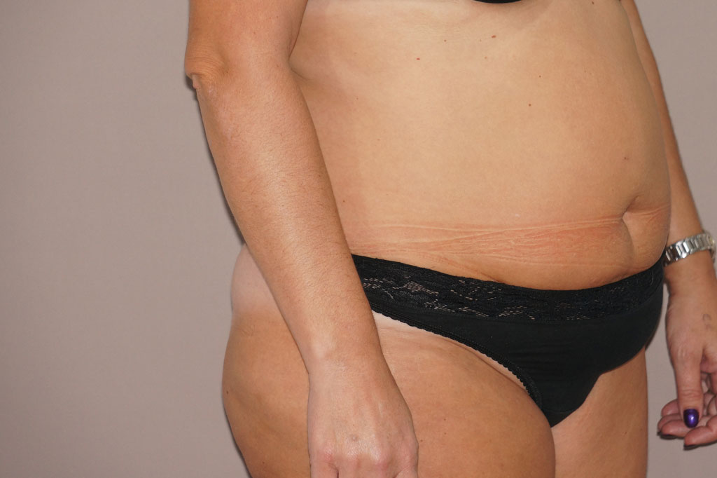 Antes Abdominoplastia reducción piel y grasa Foto caso clínico 2 vista lateral | Ocean Clinic Marbella Madrid