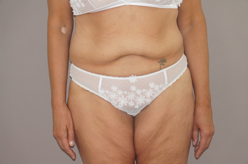 Bauchdeckenstraffung 21 BAUCHSTRAFFUNG ABDOMINOPLASTIK GLATTER UND FESTER BAUCH ante-op profil