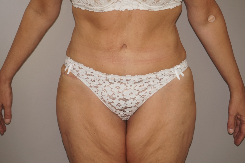 Bauchdeckenstraffung 21 BAUCHSTRAFFUNG ABDOMINOPLASTIK GLATTER UND FESTER BAUCH post-op profil