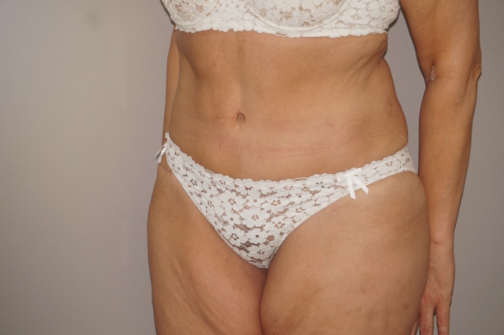 Bauchdeckenstraffung 21 BAUCHSTRAFFUNG ABDOMINOPLASTIK GLATTER UND FESTER BAUCH post-op lateral