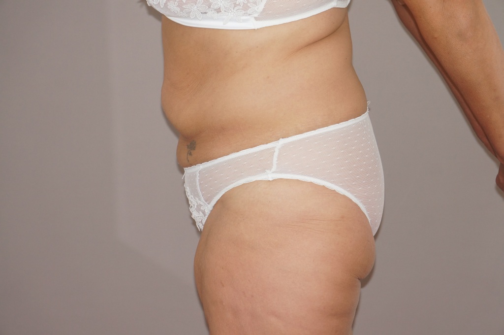 Bauchdeckenstraffung Abdominoplastik ante/post-op III