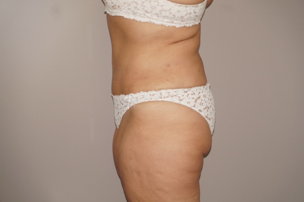 Tummy Tuck REMOVED EXCESS FAT AND SKIN ante/post-op III