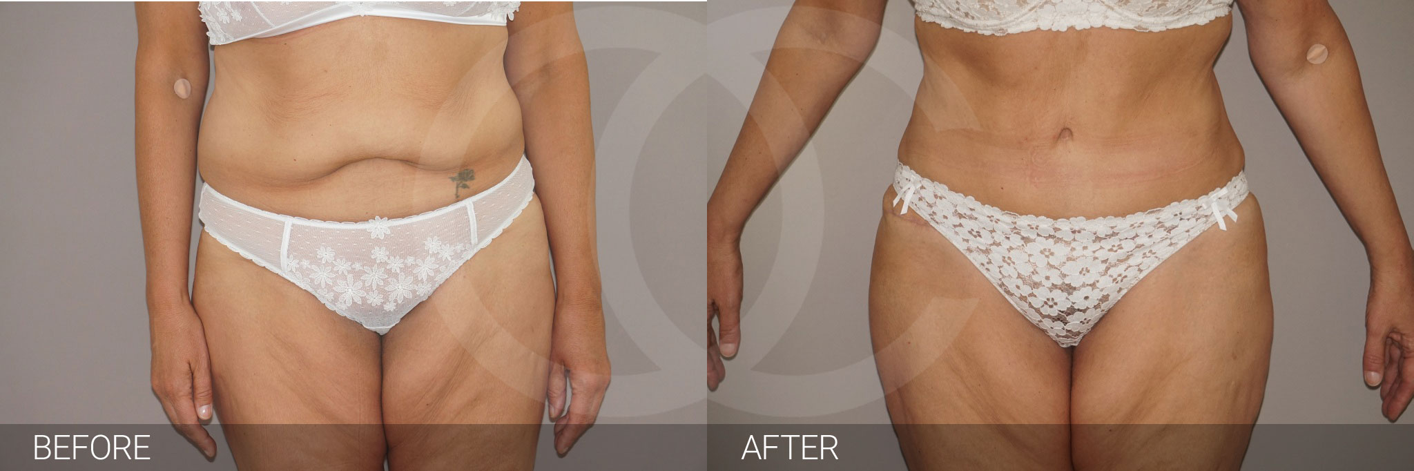 Tummy Tuck REMOVED EXCESS FAT AND SKIN ante/post-op I