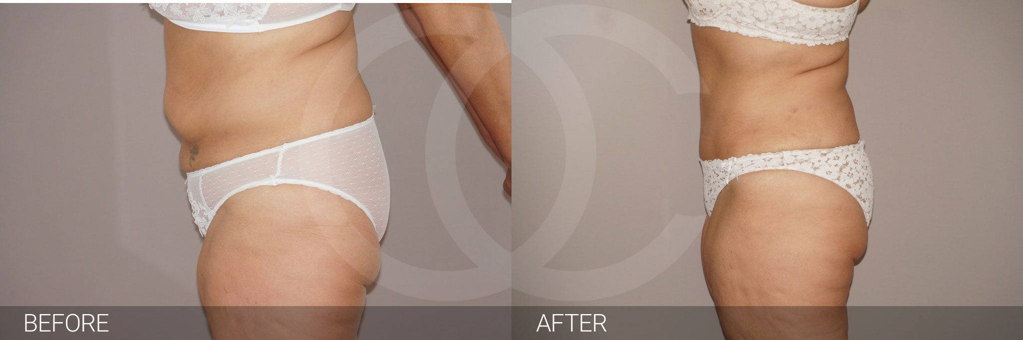Tummy Tuck REMOVED EXCESS FAT AND SKIN ante/post-op III