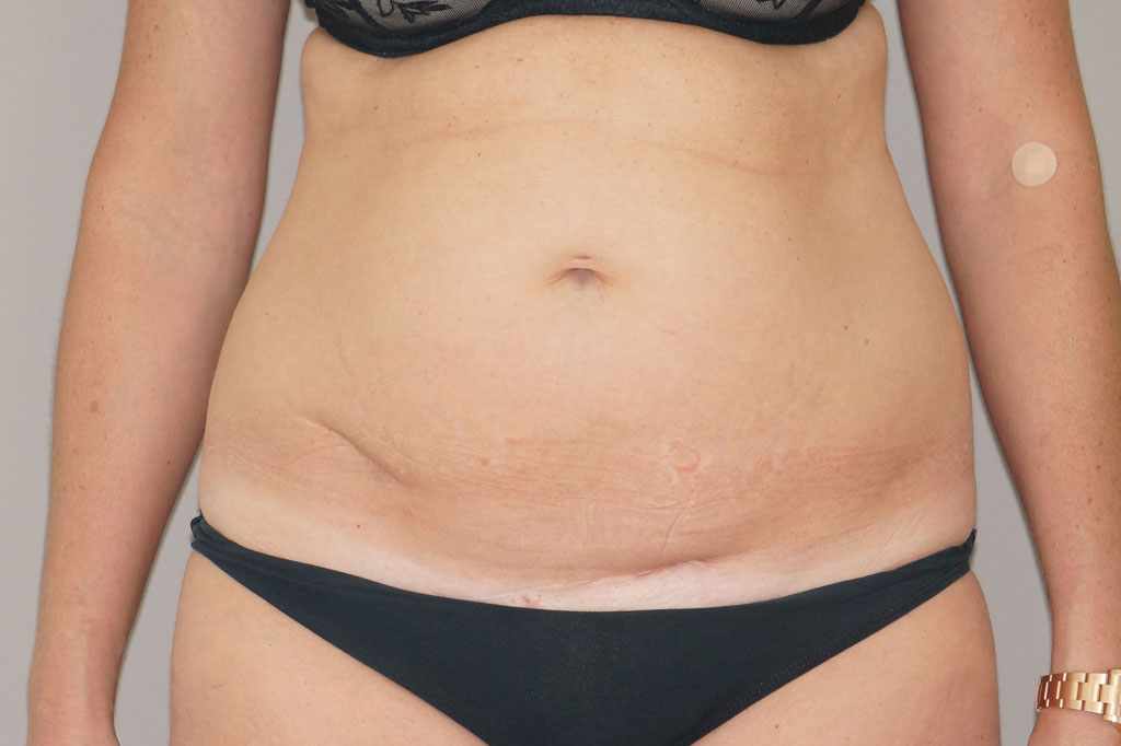 Bauchdeckenstraffung 20 BAUCHSTRAFFUNG ABDOMINOPLASTIK REKTUSDIASTASE ante-op profil