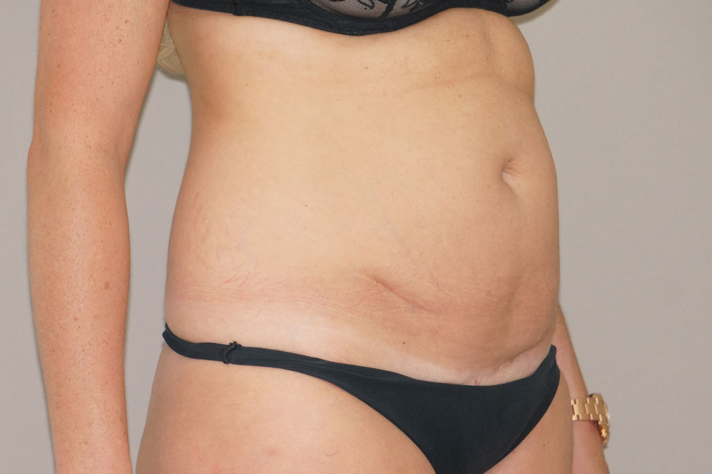 Bauchdeckenstraffung 20 BAUCHSTRAFFUNG ABDOMINOPLASTIK REKTUSDIASTASE ante-op lateral