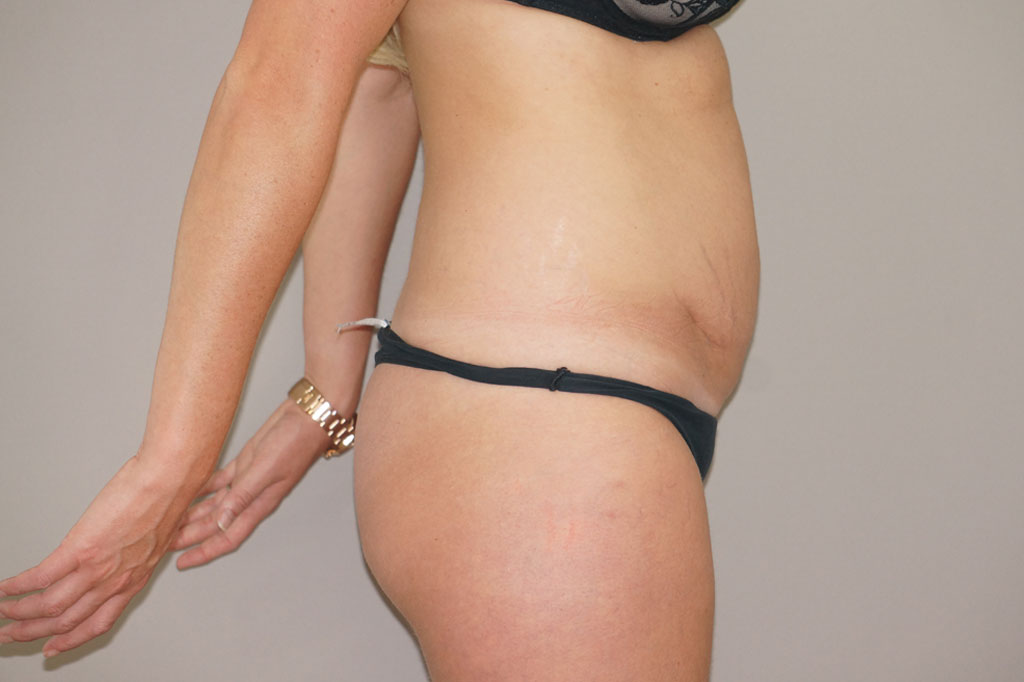 Antes Abdominoplastia reducción de abdomen Foto caso clínico 4 vista lateral | Ocean Clinic Marbella Madrid