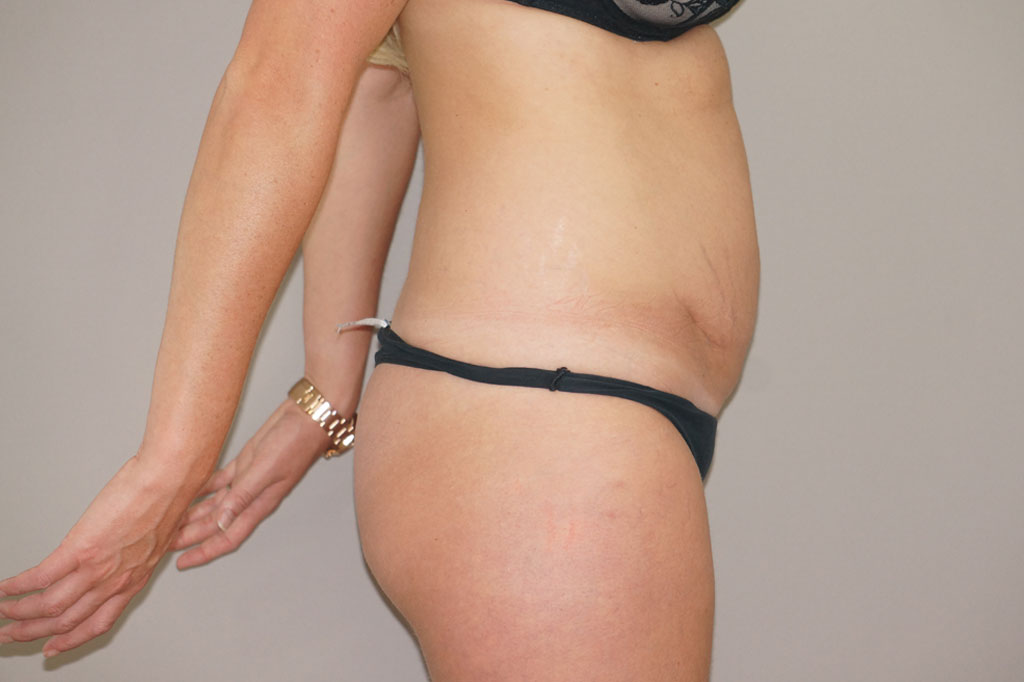 Tummy Tuck RESTORED MUSCLES ante/post-op III