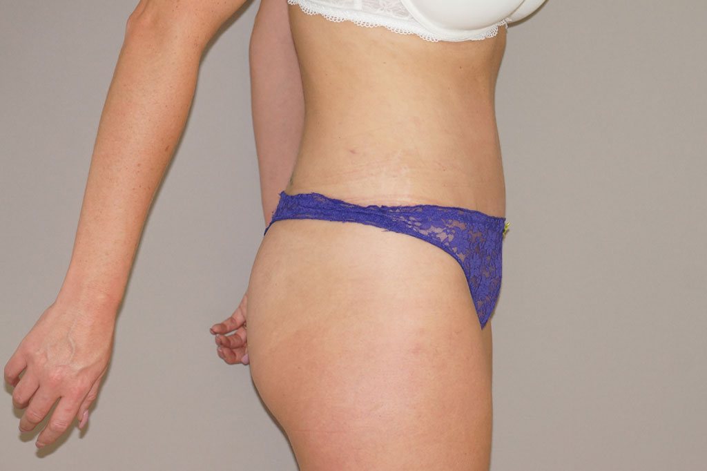 Tummy Tuck RESTORED MUSCLES ante/post-op III