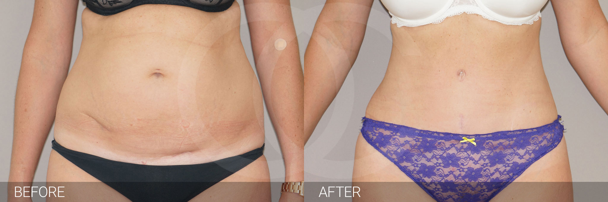 Antes y después Abdominoplastia reducción de abdomen fotos reales de pacientes 4.1 | Ocean Clinic Marbella Madrid