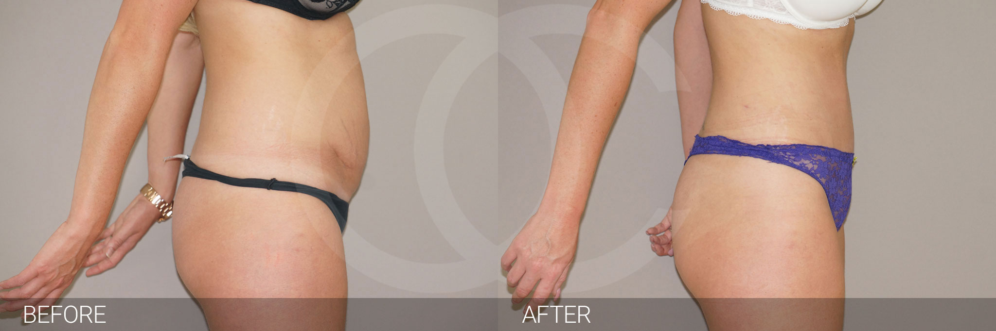 Antes y después Fotos de reducción de abdomen fotos reales de pacientes 4.3 | Ocean Clinic Marbella Madrid