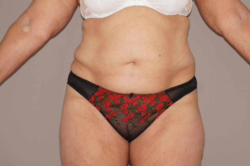 Abdominoplastie 5 ante-op profil