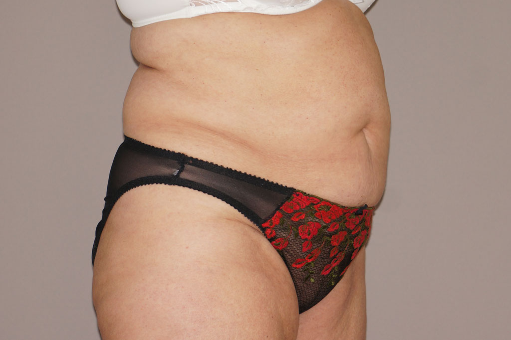 Tummy Tuck WITH LIPOSUCTION ante/post-op II