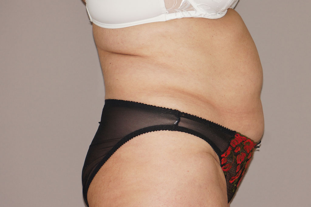 Bauchdeckenstraffung LIPO-ABDOMINOPLASTIK ante/post-op III