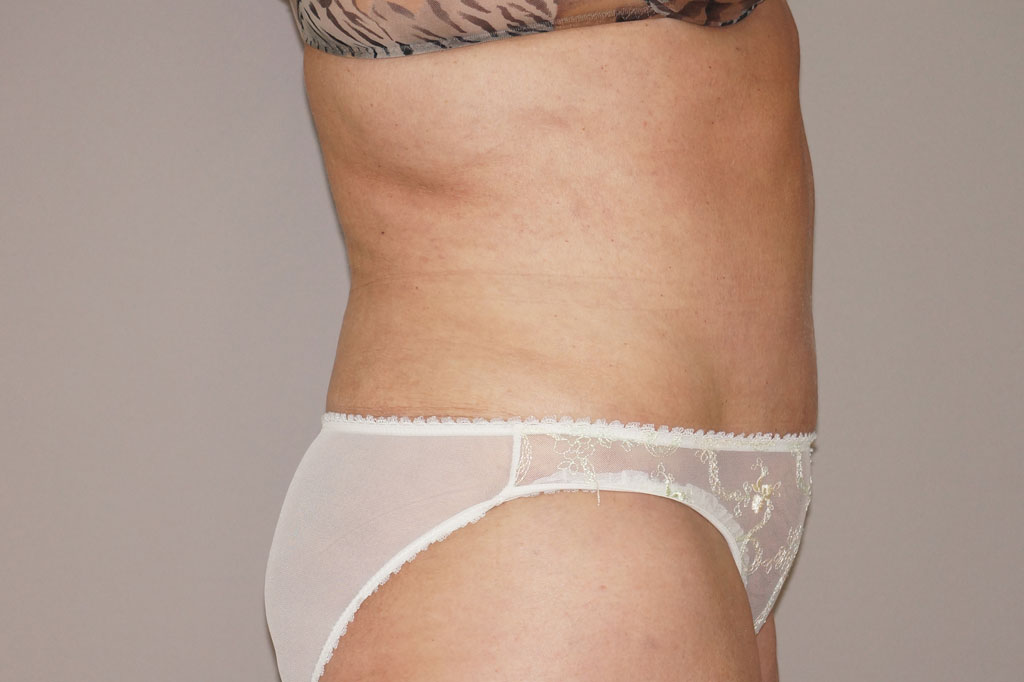 Tummy Tuck WITH LIPOSUCTION post-op retro/lateral