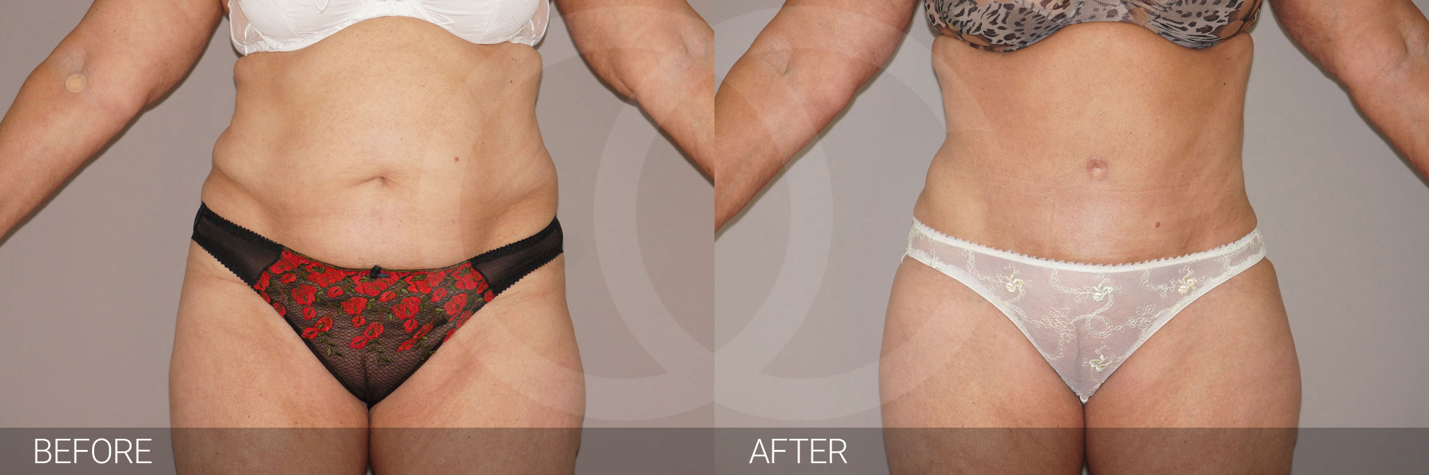Tummy Tuck WITH LIPOSUCTION ante/post-op I