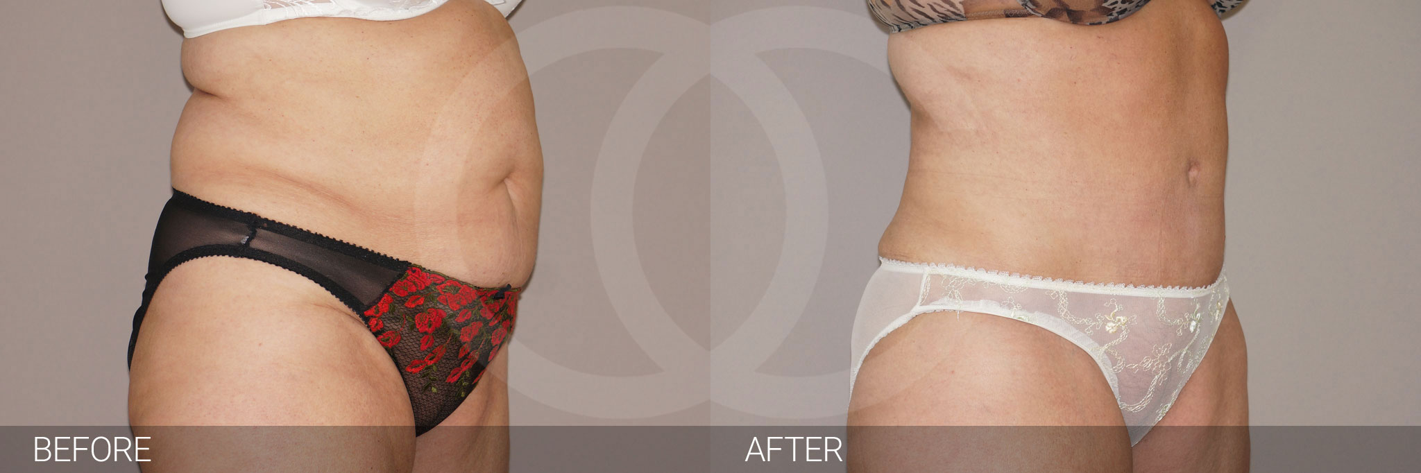 Tummy Tuck WITH LIPOSUCTION ante/post-op II
