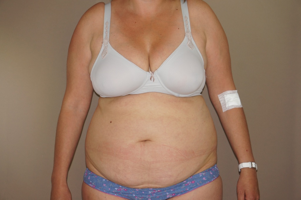 Bauchdeckenstraffung Abdominoplastik ante/post-op I