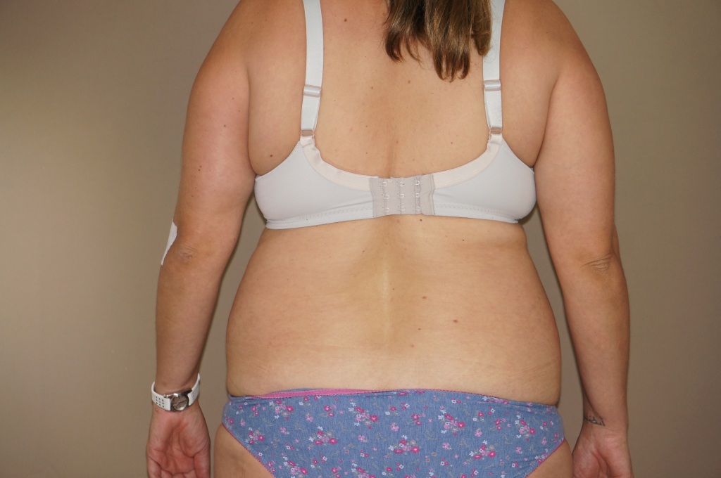 Tummy Tuck RESTORED MUSCLES ante-op lateral