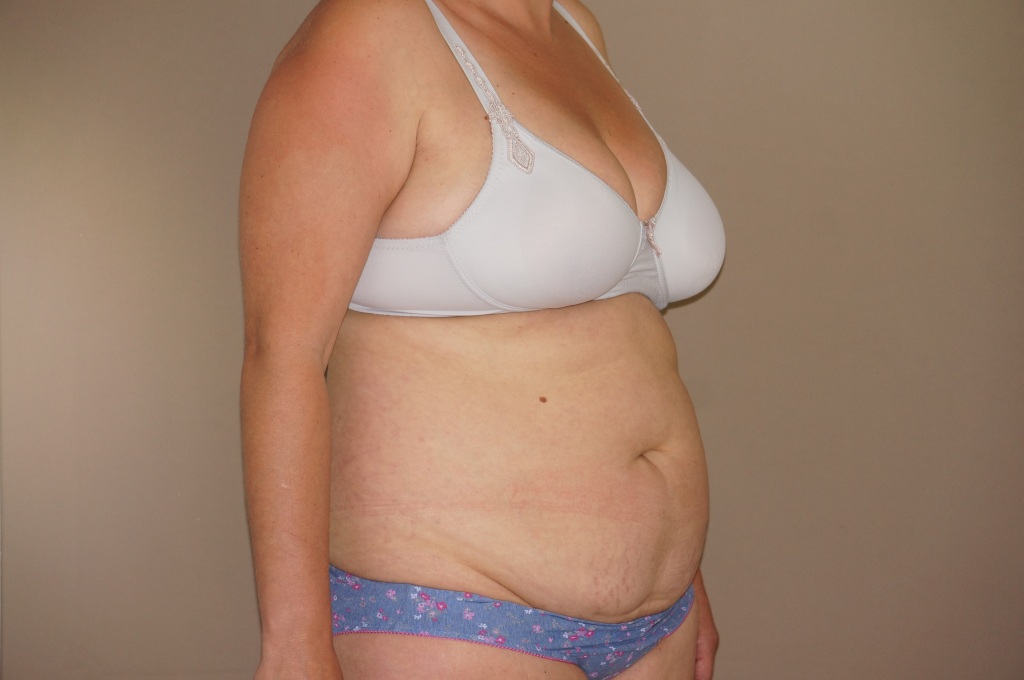 Tummy Tuck RESTORED MUSCLES ante/post-op III