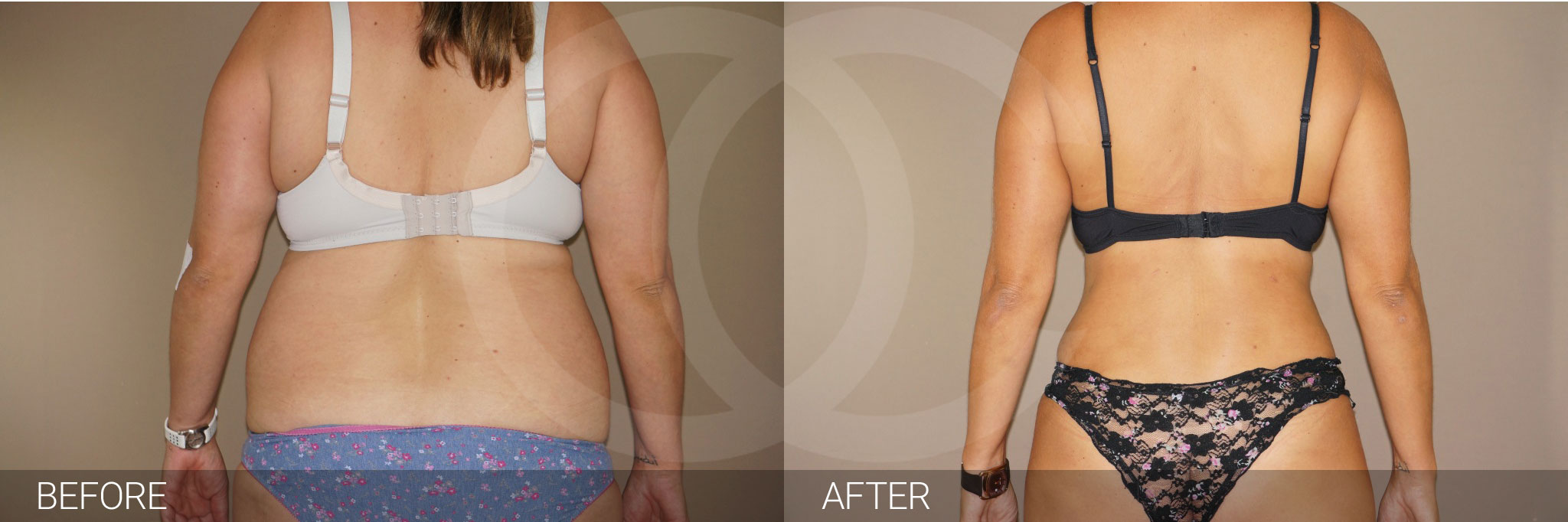 Antes y después Fotos de cirugía de abdomen fotos reales de pacientes 6.2 | Ocean Clinic Marbella Madrid