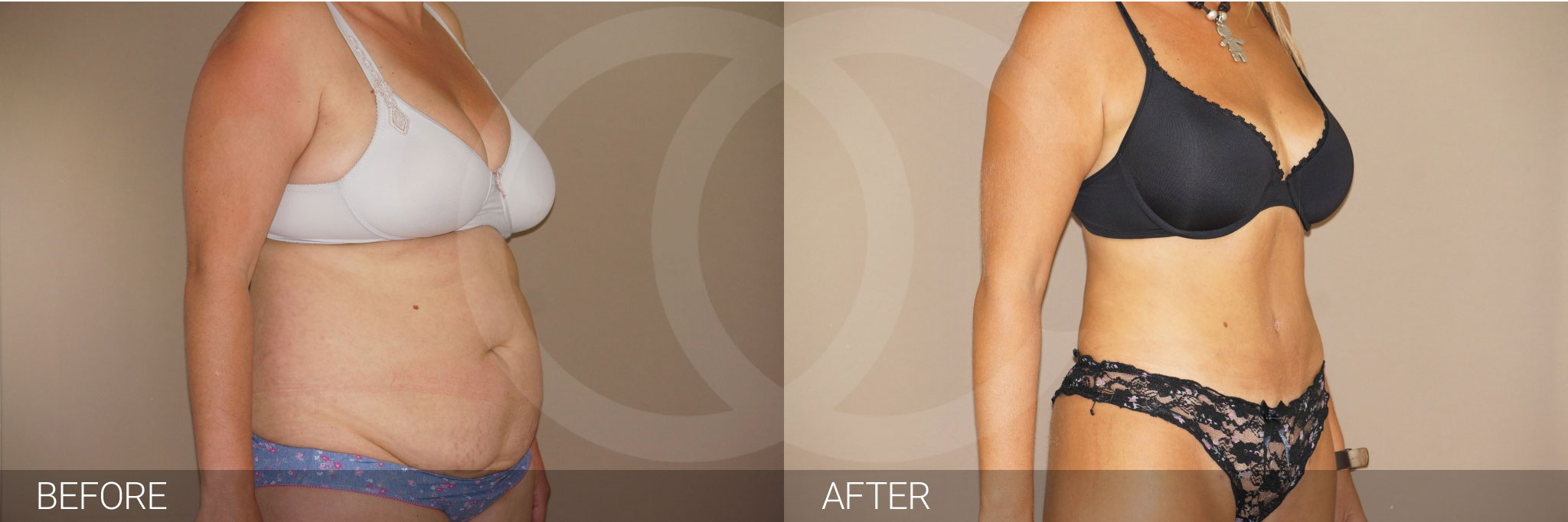 Antes y después Abdominoplastia cirugía de abdomen fotos reales de pacientes 6.3 | Ocean Clinic Marbella Madrid