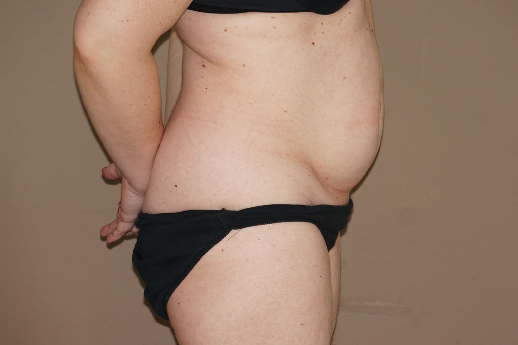 Tummy Tuck LIPOABDOMINOPLASTY ante/post-op III