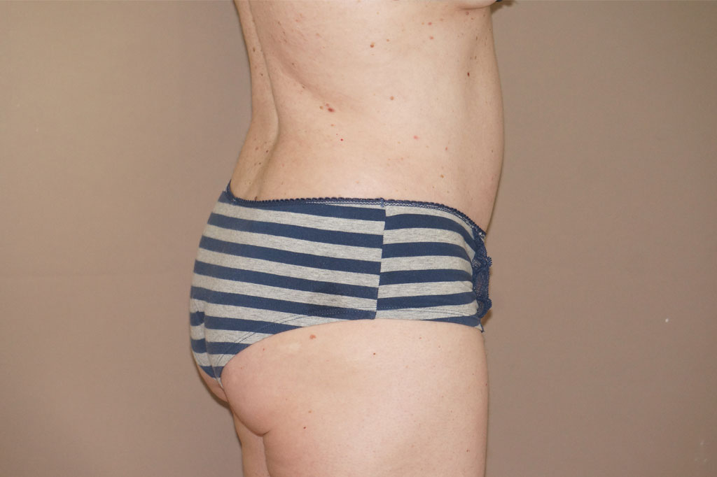 Abdominoplastie 7 post-op retro/lateral