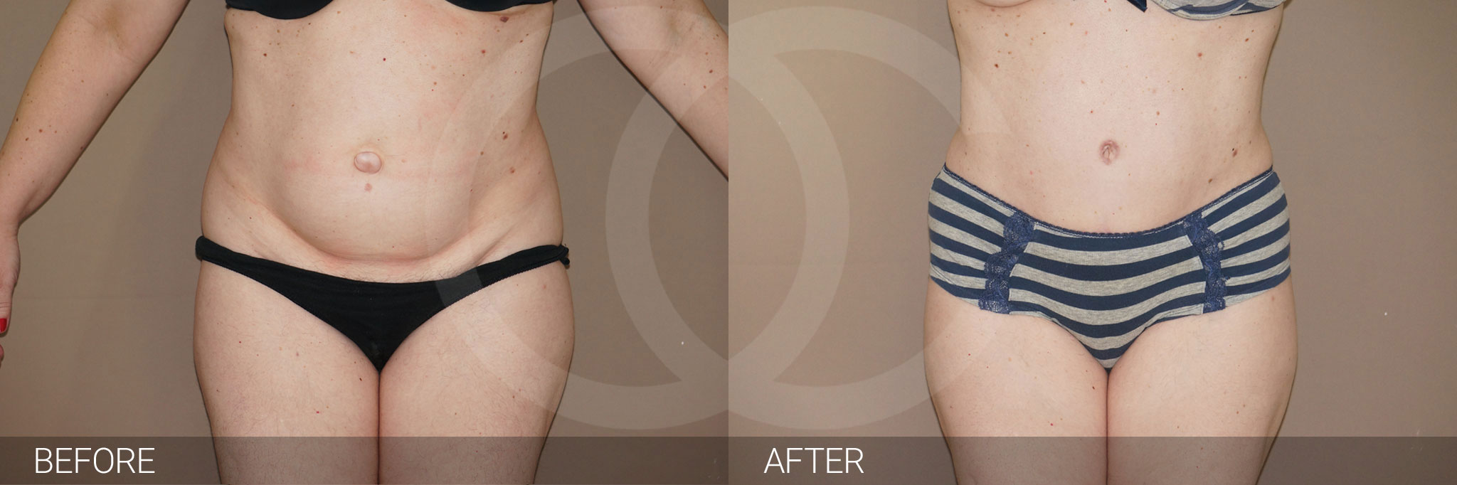 Antes y después Abdominoplastia con liposucción fotos reales de pacientes 7.1 | Ocean Clinic Marbella Madrid