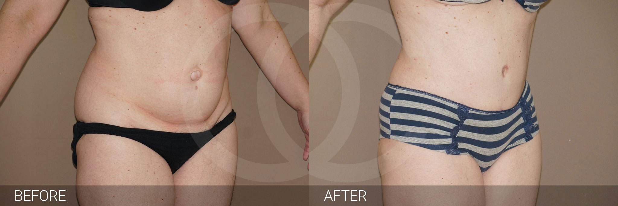 Antes y después Fotos de contorno abdominal fotos reales de pacientes 7.2 | Ocean Clinic Marbella Madrid